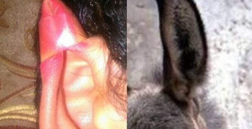 Donkey-ear-cosmetic-surgery-1
